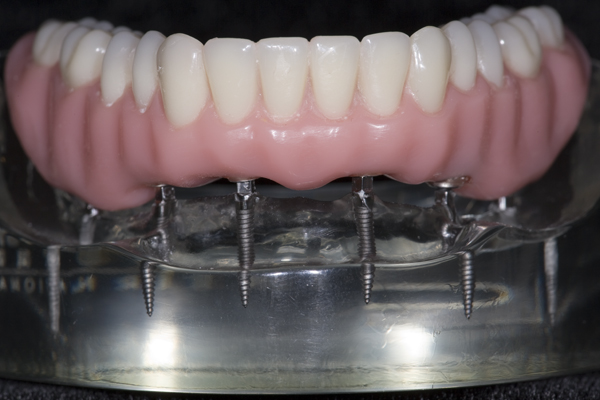 wflOringdenture.jpg