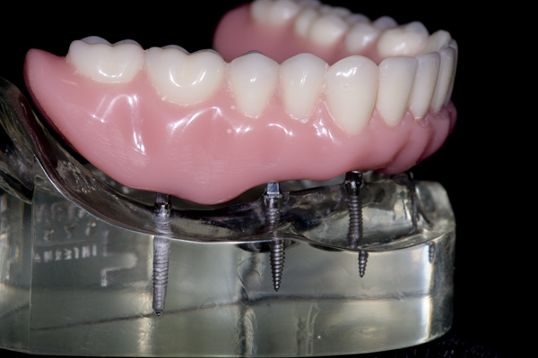 wflOringdenture2.jpg