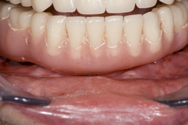 wflhygienicgap.jpg