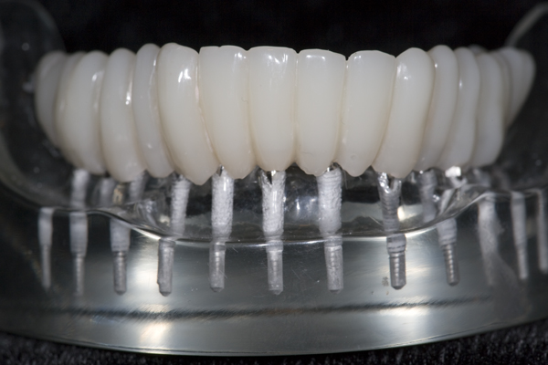 wflteethonimplantmodel.jpg