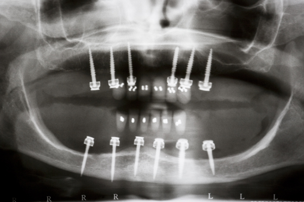 wflwandaO_ringdenture.jpg
